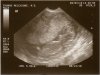 Brei ultrasound 3 months.jpg